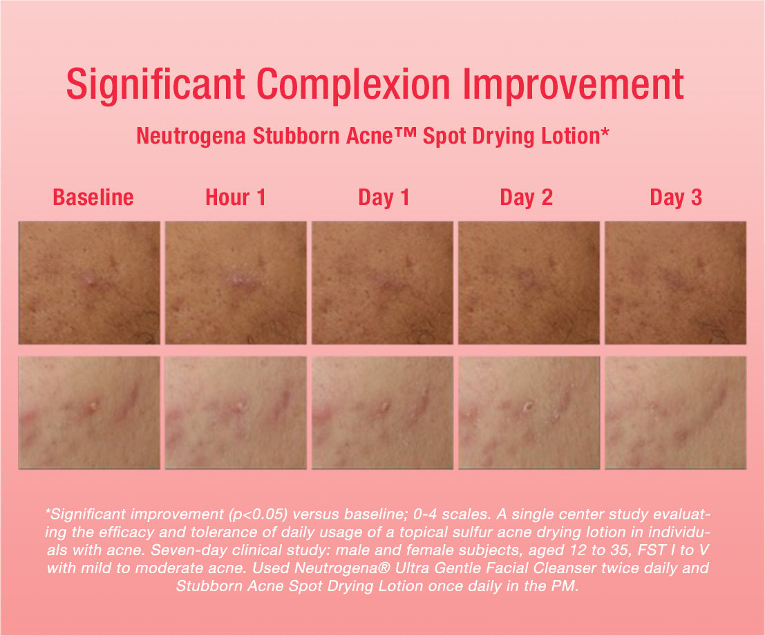 Neutrogena Stubborn Acne Significant Complexion Improvement